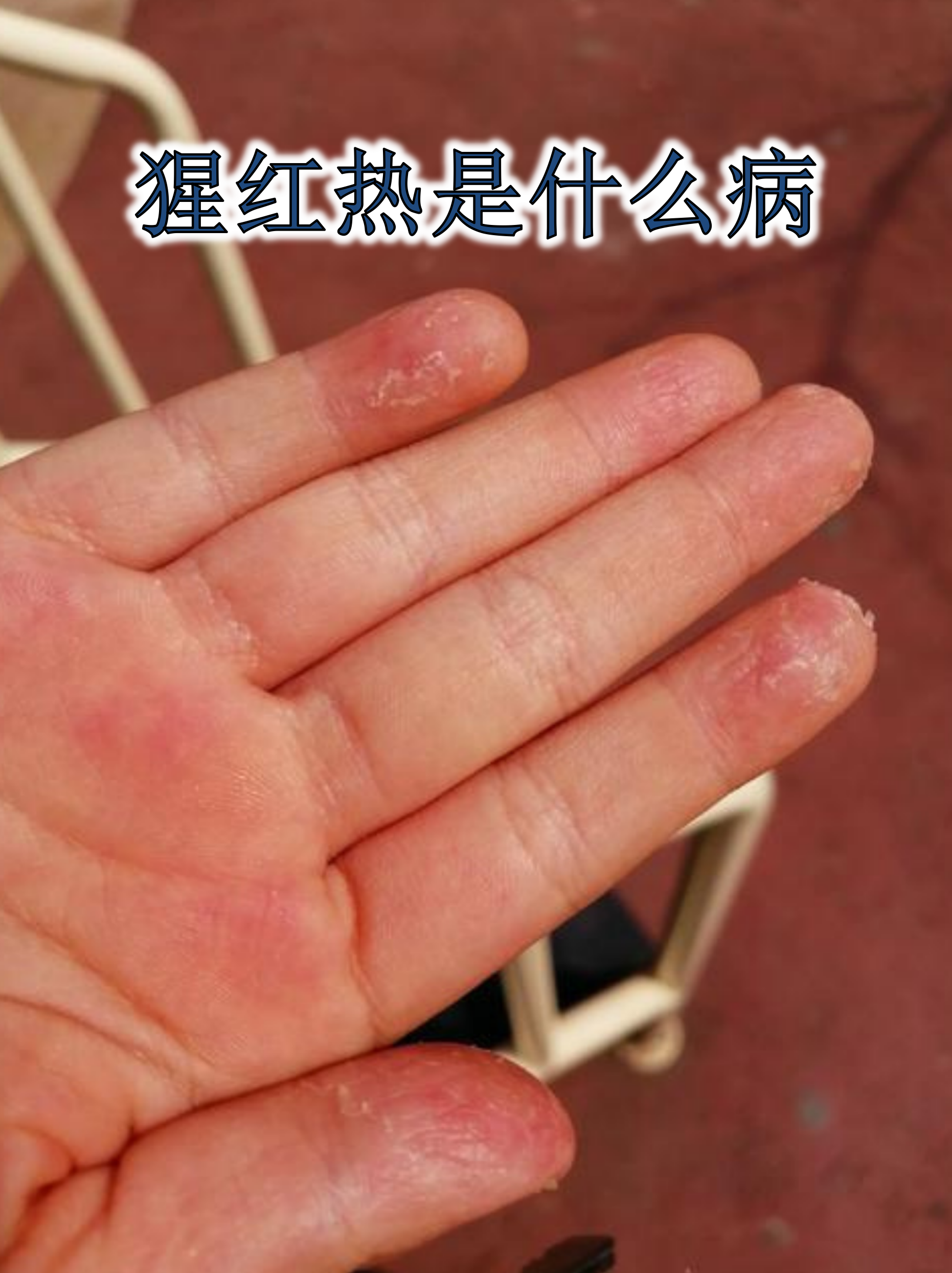 【历史上出血热疫情_出血热最早出现的症状是】