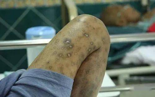 【传染病疫情症状,传染疫情有什么症状】